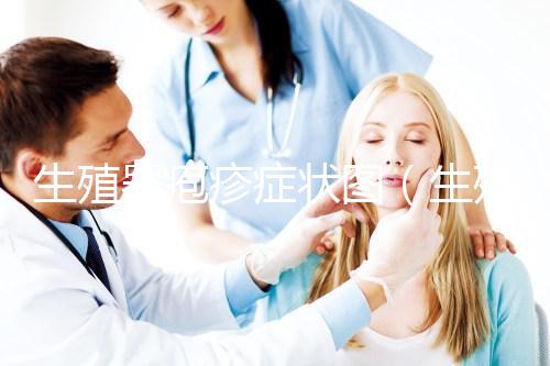 生殖器皰疹癥狀圖(生殖皰疹的圖案大全)