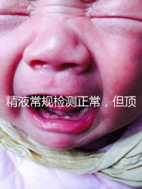 精液常規(guī)檢測(cè)正常,但頂體酶低,是否影響試管嬰兒成功率?