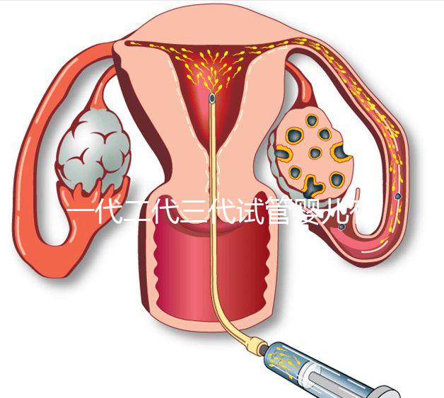 一代二代三代試管嬰兒有什么區別？