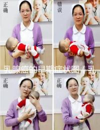 乳腺癌的早期癥狀圖(乳頭狀瘤早期圖片)