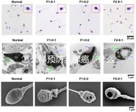 怎么樣預防乳腺癌(什么人容易得乳腺癌)