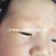 河南省人民醫院無痛分娩多少錢戳，收費標準60s看懂不踩坑